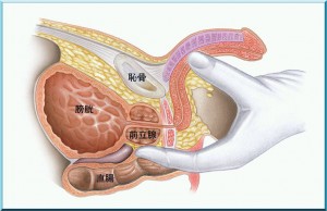 prostate_cancer_img002