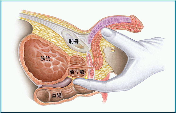 前立腺癌はどのようにしてみつかるの?